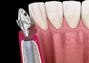 A 3D illustration of a dental implant abutment being placed